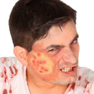 CICATRIZ AMPOLLAS LATEX