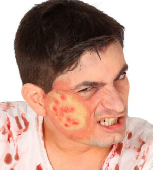 CICATRIZ AMPOLLAS LATEX